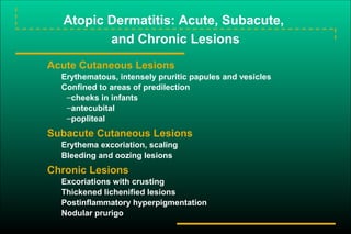 Urticaria&angioedema(copiedsenior) | PPT