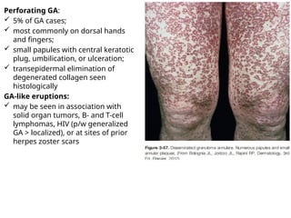 Urticaria and angioedema for dermatology | PPTX