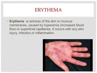 ERYTHEMA
• Erythema is redness of the skin or mucous
membranes, caused by hyperemia (increased blood
flow) in superficial capillaries. It occurs with any skin
injury, infection,or inflammation.
 