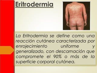 La Eritrodermia se define como una
reacción cutánea caracterizada por
enrojecimiento uniforme y
generalizado, con descamación que
compromete el 90% o más de la
superficie corporal cutánea.
 