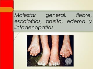 Malestar general, fiebre,
escalofríos, prurito, edema y
linfadenopatías.
 