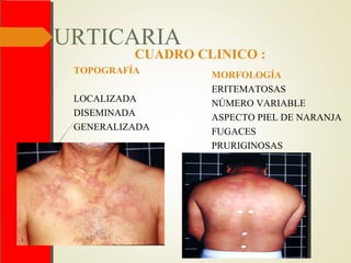 URTICARIA
CUADRO CLINICO :
TOPOGRAFÍA
LOCALIZADA
DISEMINADA
GENERALIZADA
MORFOLOGÍA
ERITEMATOSAS
NÚMERO VARIABLE
ASPECTO PIEL DE NARANJA
FUGACES
PRURIGINOSAS
 