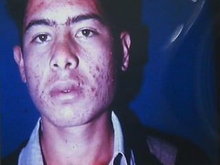 Urticaria, eritema, eritroderma