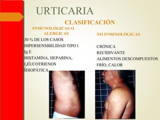 URTICARIA
INMUNOLÓGICAS O
ALERGICAS
30 % DE LOS CASOS
HIPERSENSIBILIDAD TIPO I
Ig E
HISTAMINA, HEPARINA,
LEUCOTRIENOS
IDIOPÁTICA
NO INMINOLÓGICAS
CRÓNICA
RECIDIVANTE
ALIMENTOS DESCOMPUESTOS
FRÍO, CALOR
CLASIFICACIÓN :
 