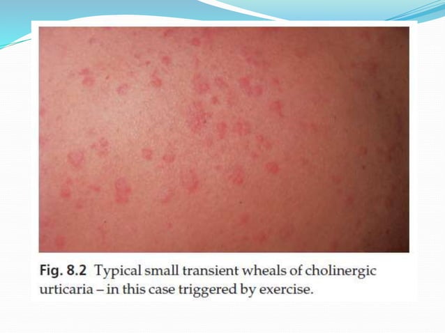 Urticaria (hives, ‘nettle rash’) | PPTX