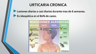 URTICARIA CRONICA 
►Lesiones diarias o casi diarias durante mas de 6 semanas. 
►Es ideopática en el 80% de casos. 
 