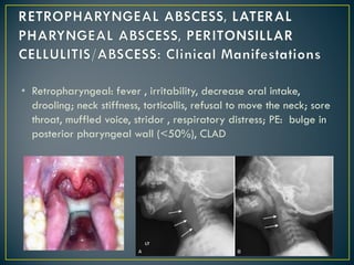 • Retropharyngeal: fever , irritability, decrease oral intake,
drooling; neck stiffness, torticollis, refusal to move the neck; sore
throat, muffled voice, stridor , respiratory distress; PE: bulge in
posterior pharyngeal wall (<50%), CLAD
 