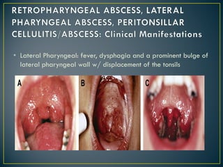• Lateral Pharyngeal: fever, dysphagia and a prominent bulge of
lateral pharyngeal wall w/ displacement of the tonsils
 