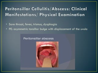 • Sore throat, fever, trismus, dysphagia
• PE: asymmetric tonsillar bulge with displacement of the uvula
 