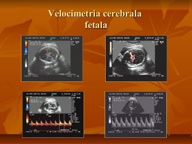 doppler ultrasound pregnancy for nclex doppler ultrasound pregnancy for nclex