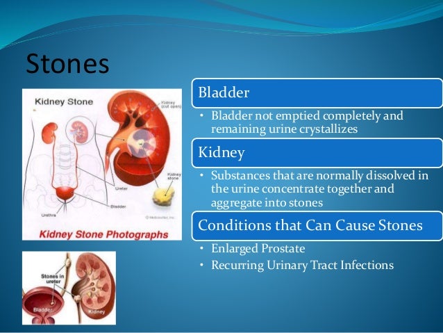 is terazosin used for kidney stones