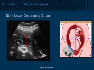 Phelan Normal ultrasonography of amniotic fluid | PDF