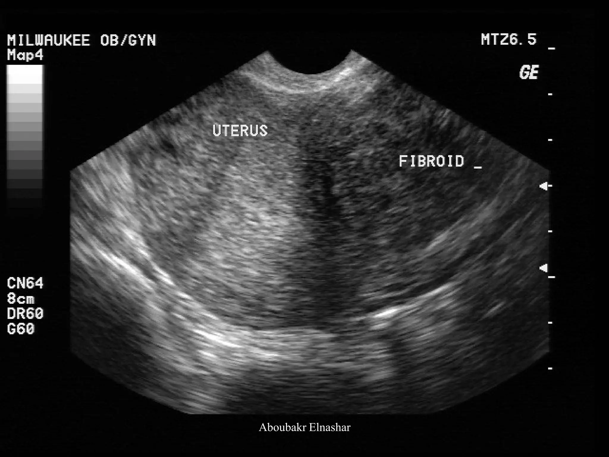 Uturus Graph Ultrasonography of the uterus | PDF