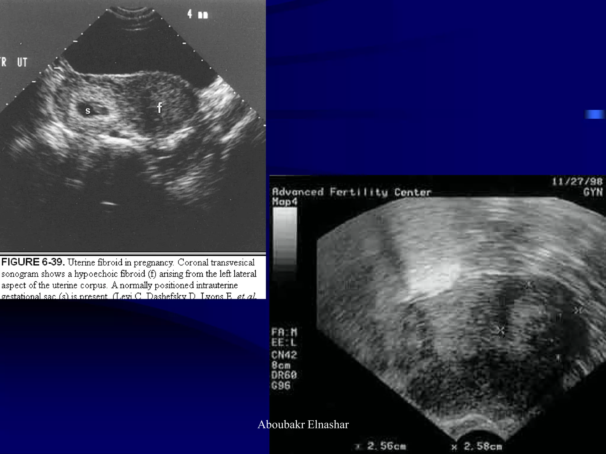 Uturus Graph Ultrasonography of the uterus | PDF