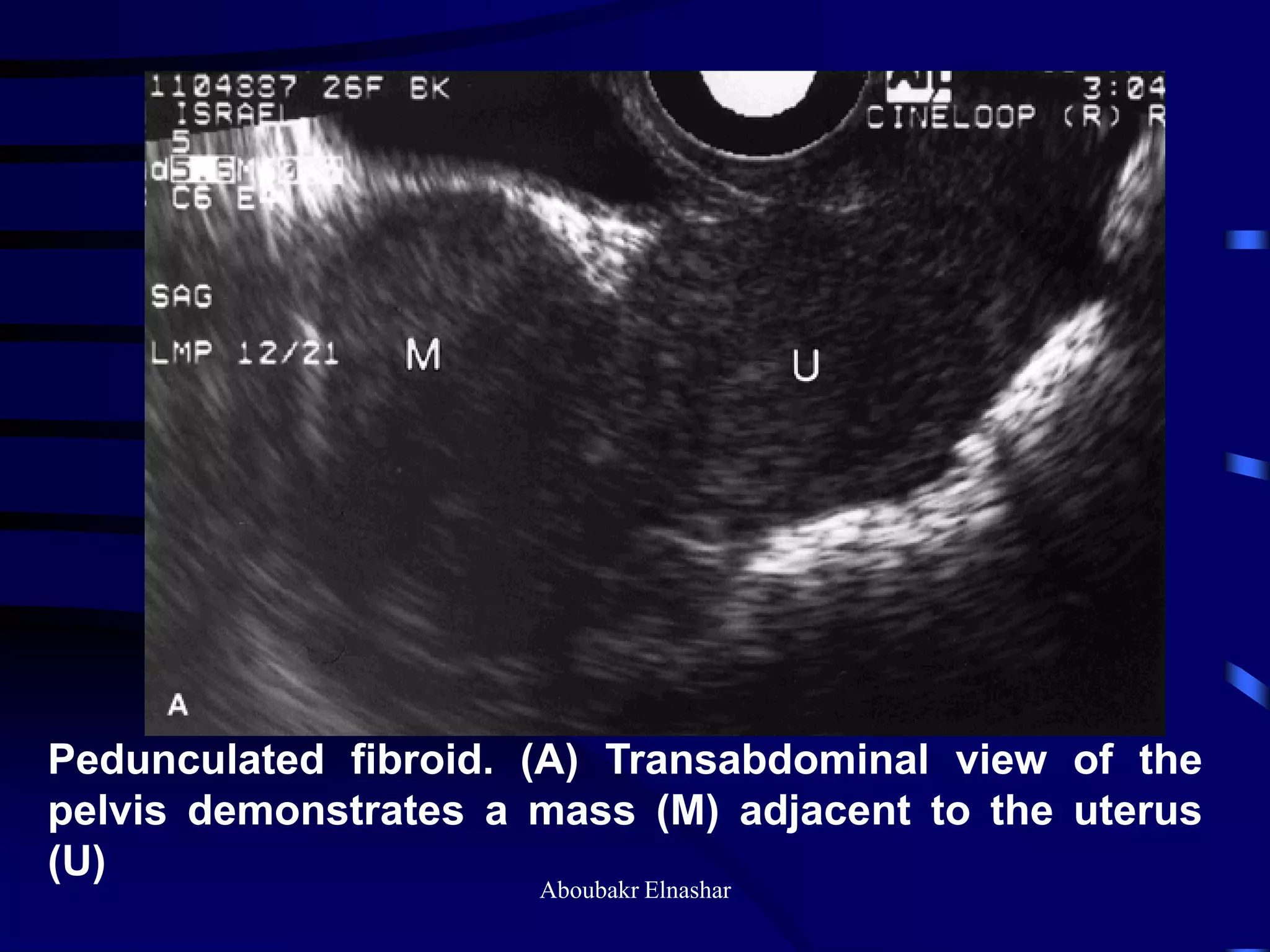 Uturus Graph Ultrasonography of the uterus | PDF