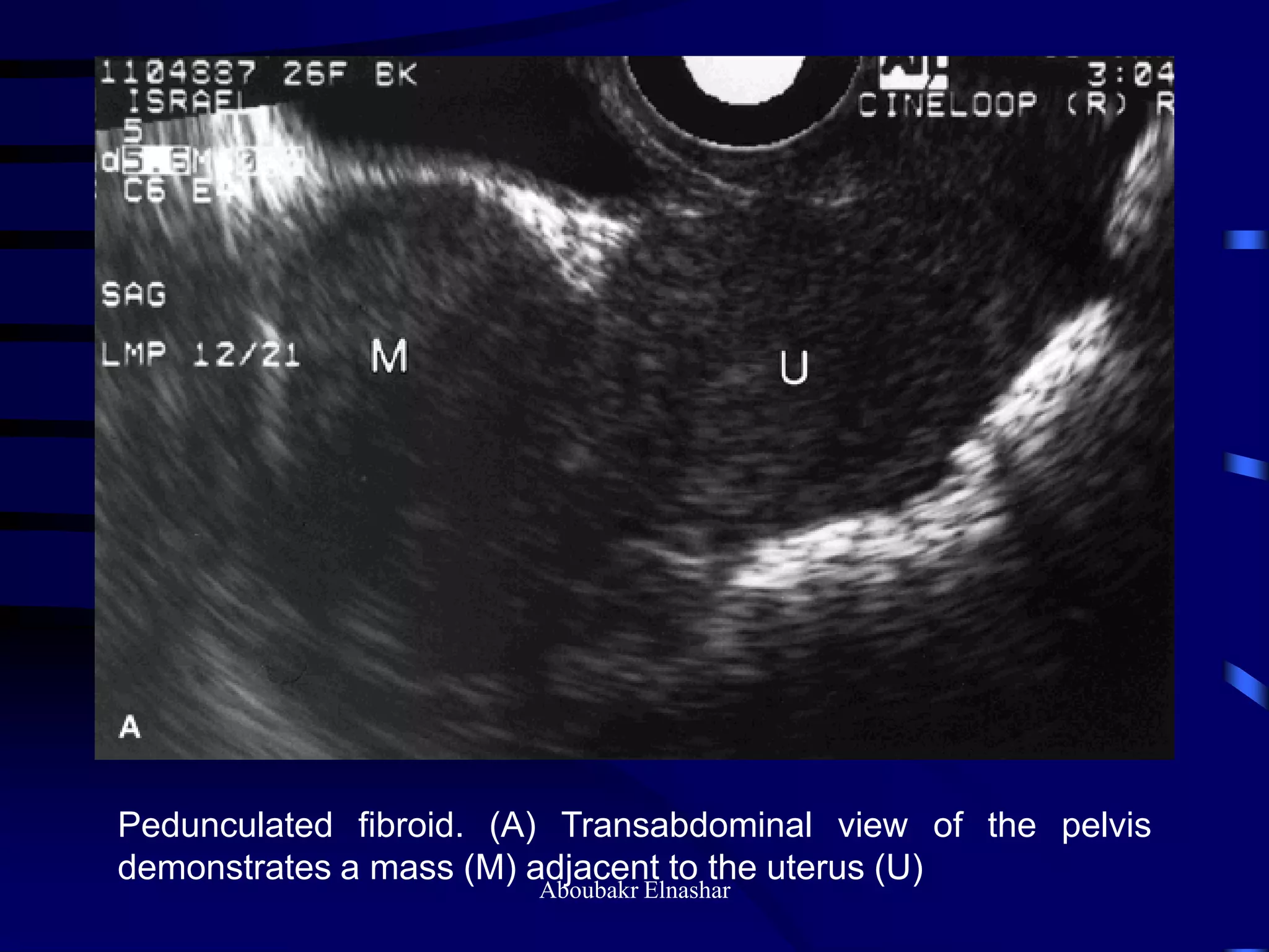 Uturus Graph Ultrasonography of the uterus | PDF