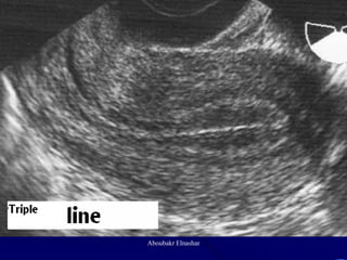 Uturus Graph Ultrasonography of the uterus | PDF