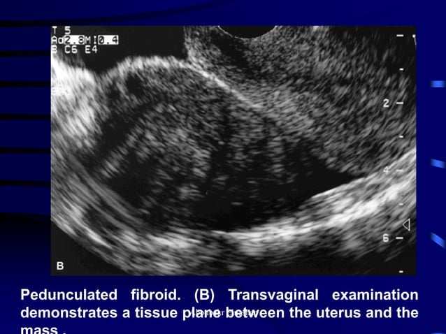 Uturus Graph Ultrasonography of the uterus | PDF | Pregnancy | Reproductive Health