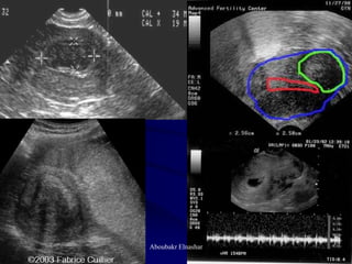 Uturus Graph Ultrasonography of the uterus | PDF