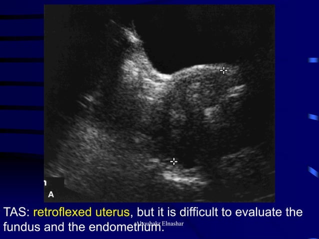 Uturus Graph Ultrasonography of the uterus | PDF | Pregnancy | Reproductive Health