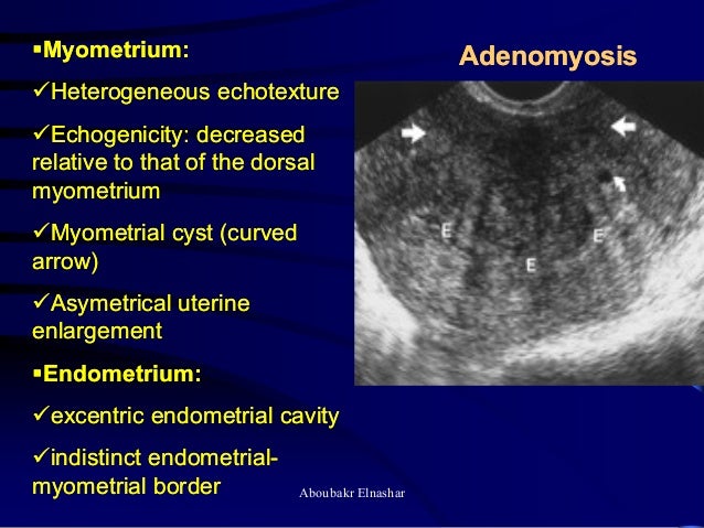 Ultrasonography Of The Uterus