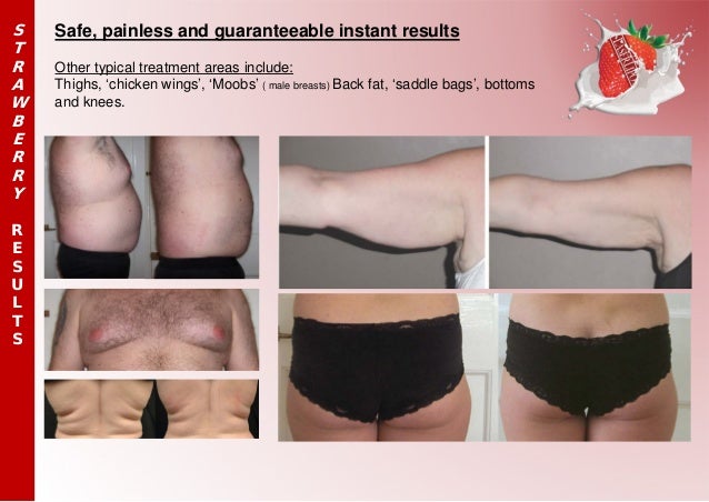 liposuction risks