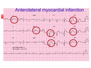 ECG Interpretation by USAMA ELSAYED | PPT