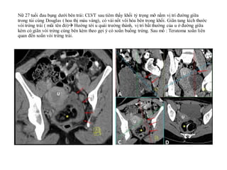Ca lâm sàng: Xoắn Buồng trứng trái (MRI)
• Bn nữ, 25 tuổi. Đau bụng vùng hạ vị âm ỉ kéo dài đã 2 tháng nay, siêu
âm thấy k...