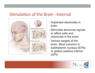 S-mula-on	
  of	
  the	
  Brain	
  -­‐	
  Internal	
  
•  Implanted electrodes in
brain
•  Stimulate abnormal signals
or affect cells and
chemicals in the brain
•  Various targets of the
brain. Most common is
subthalamic nucleus (STN)
or globus pallidus interna
(GPI)
 
