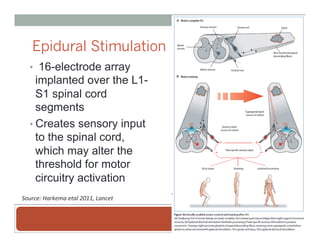 Epidural Stimulation
•  16-electrode array
implanted over the L1-
S1 spinal cord
segments
• Creates sensory input
to the spinal cord,
which may alter the
threshold for motor
circuitry activation
Source:	
  Harkema	
  etal	
  2011,	
  Lancet	
  
 