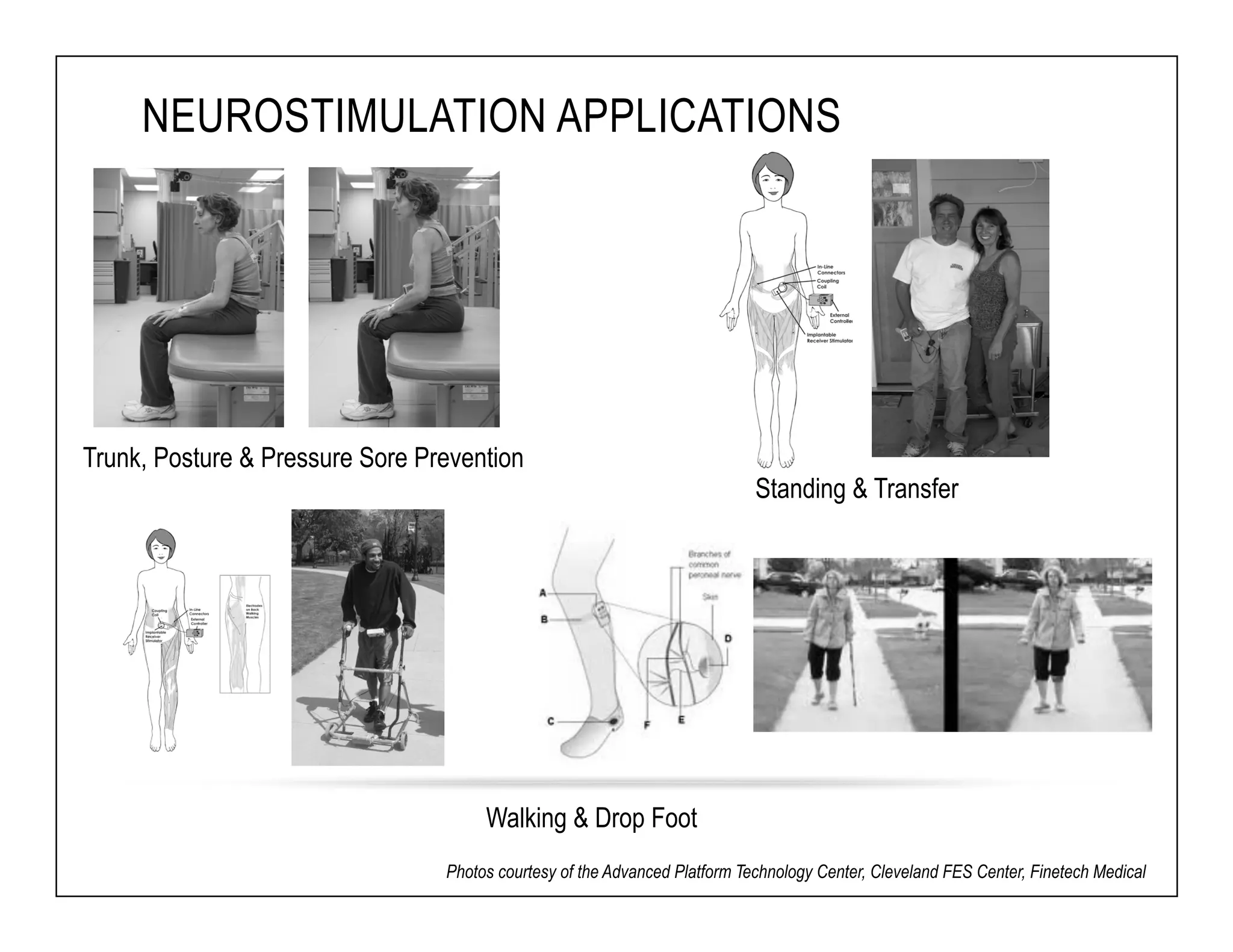 NEUROSTIMULATION APPLICATIONS 
Trunk, Posture & Pressure Sore Prevention 
Standing & Transfer 
Walking & Drop Foot 
Photos courtesy of the Advanced Platform Technology Center, Cleveland FES Center, Finetech Medical 
 