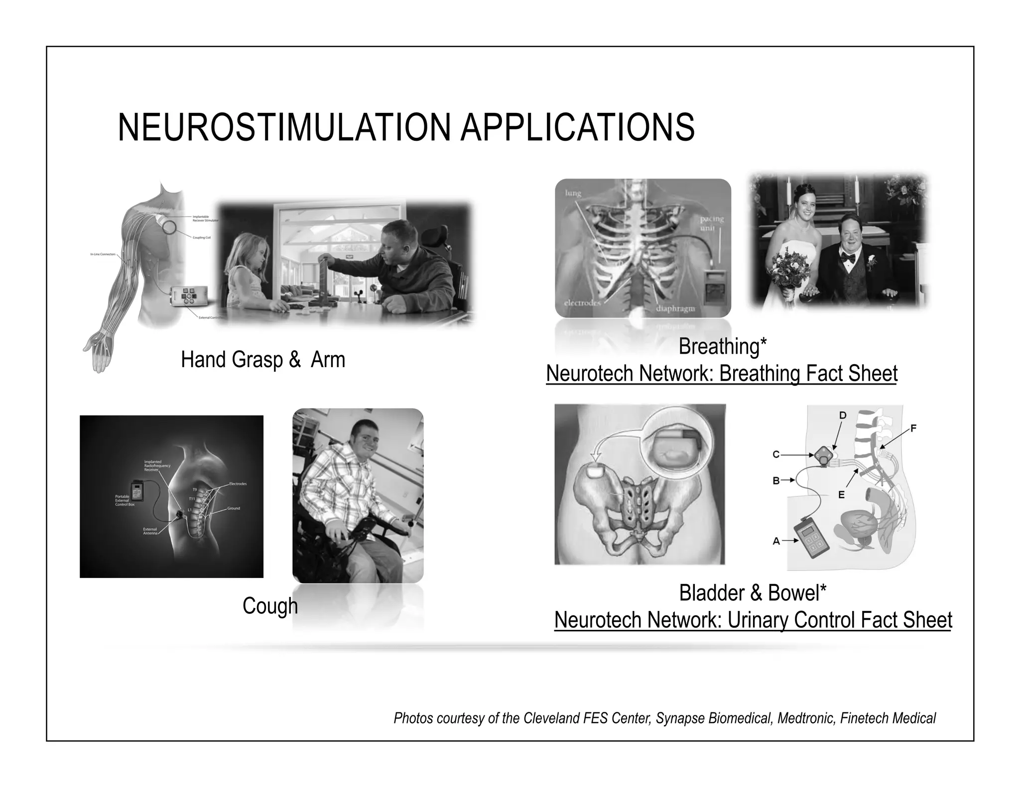 NEUROSTIMULATION APPLICATIONS 
Breathing* 
Neurotech Network: B Hand Grasp & Arm reathing Fact Sheet 
Bladder & Bowel* 
Neurotech Network: Urinary Control Fact Sheet 
Cough 
Photos courtesy of the Cleveland FES Center, Synapse Biomedical, Medtronic, Finetech Medical 
 