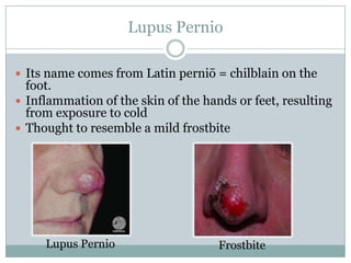 Pernio lupus Cutaneous Sarcoidosis: