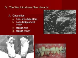 IV. The War Introduces New HazardsIV. The War Introduces New Hazards
A. CasualtiesA. Casualties
a.a. Lice, rats,Lice, rats, dysenterydysentery
b.b. battlebattle fatiguefatigue /shell/shell
shockshock
c.c. trenchtrench footfoot
d.d. trenchtrench mouthmouth
 