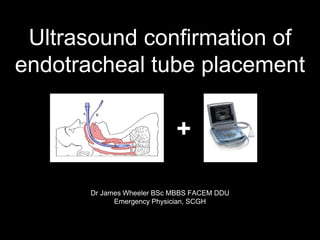 Ultrasound confirmation of
endotracheal tube placement
Dr James Wheeler BSc MBBS FACEM DDU
Emergency Physician, SCGH
+
 