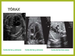 Corte de las 4 cámaras Corte de las 5 cámaras Corte de los tres vasos
 