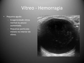 Vítreo - Hemorragia
• Pequena aguda:
- Ecogenicidade vítrea
normal ou pouco
aumentada.
- Pequenas partículas
móveis no interior do
vítreo.
 