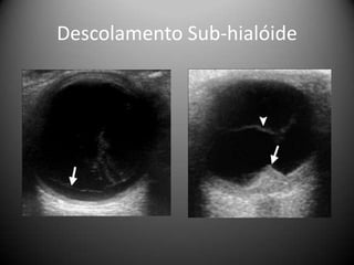 Descolamento Sub-hialóide
 