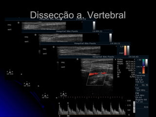 Dissecção a. Vertebral
 