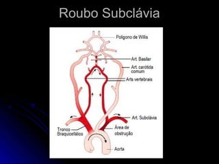 Roubo Subclávia
 
