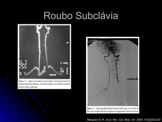 Roubo Subclávia
Marques S .R., et al. Rev. Col. Bras. Cir. 2004, 31(3)220-222
 
