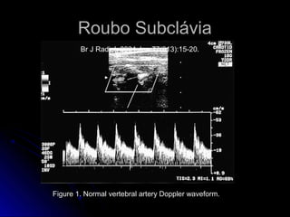 Roubo Subclávia
Figure 1. Normal vertebral artery Doppler waveform.
Br J Radiol. 2004 Jan;77(913):15-20.
 