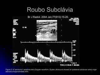 Roubo Subclávia
Figure 2. A "pre-bunny" vertebral artery Doppler waveform. Duplex ultrasound showed an ipsilateral subclavian artery origin
stenosis of approximately 50%.
Br J Radiol. 2004 Jan;77(913):15-20.
 