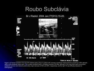 Roubo Subclávia
Figure 3. A "bunny" waveform from the left vertebral artery (VA) of a patient with coronary–subclavian steal syndrome caused by a 90% stenosis
within a left subclavian artery stent. This usually manifests itself in complete reversal of VA flow, although in this case there were concomitant
ipsilateral common and internal carotid artery origin stenoses of 50% and 90%, respectively, and the right VA was diffusely diseased on
arteriography.
Br J Radiol. 2004 Jan;77(913):15-20.
 