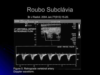 Roubo Subclávia
Figure 5. Retrograde vertebral artery
Doppler waveform.
Br J Radiol. 2004 Jan;77(913):15-20.
 