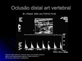 Oclusão distal art vertebral
Figure 8. High resistance vertebral artery (VA) Doppler waveform
seen in the intertransverse segment. Distal occlusion of
the VA was confirmed on angiography.
Br J Radiol. 2004 Jan;77(913):15-20.
 