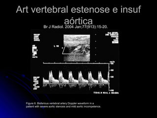 Art vertebral estenose e insuf
aórtica
Figure 6. Bisferious vertebral artery Doppler waveform in a
patient with severe aortic stenosis and mild aortic incompetence.
Br J Radiol. 2004 Jan;77(913):15-20.
 