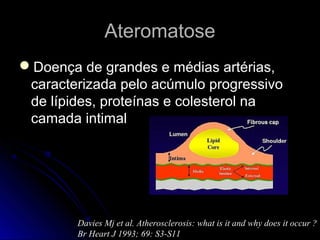 AteromatoseAteromatose
Doença de grandes e médias artérias,Doença de grandes e médias artérias,
caracterizada pelo acúmulo progressivocaracterizada pelo acúmulo progressivo
de lípides, proteínas e colesterol nade lípides, proteínas e colesterol na
camada intimalcamada intimal
Davies Mj et al. Atherosclerosis: what is it and why does it occur ?
Br Heart J 1993; 69: S3-S11
 