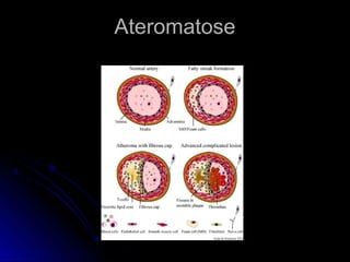 AteromatoseAteromatose
 