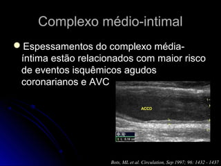 Complexo médio-intimalComplexo médio-intimal
Espessamentos do complexo média-
íntima estão relacionados com maior risco
de eventos isquêmicos agudos
coronarianos e AVC
Bots, ML et al. Circulation, Sep 1997; 96: 1432 - 1437
 